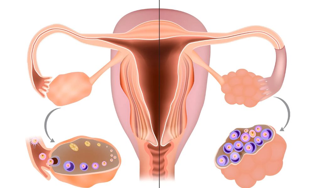 Shairaksha | IVF – In Vitro Fertilization