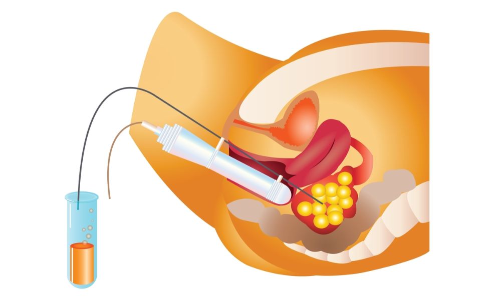 Shairaksha | IVF – In Vitro Fertilization