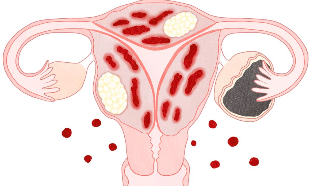 Shairaksha | Hysteroscopic Procedures