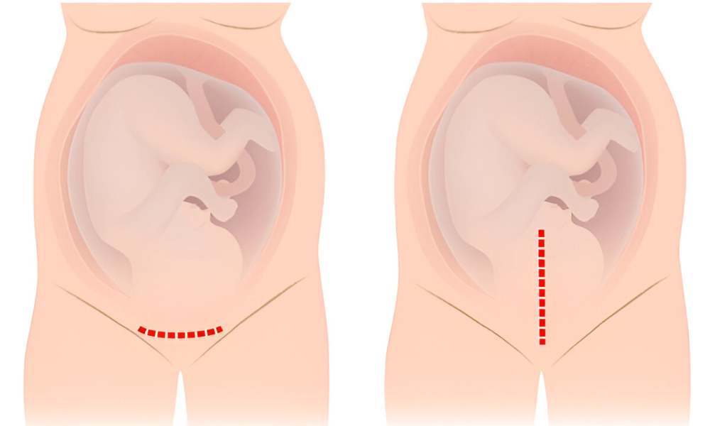 Shairaksha | Cesarean Deliveries