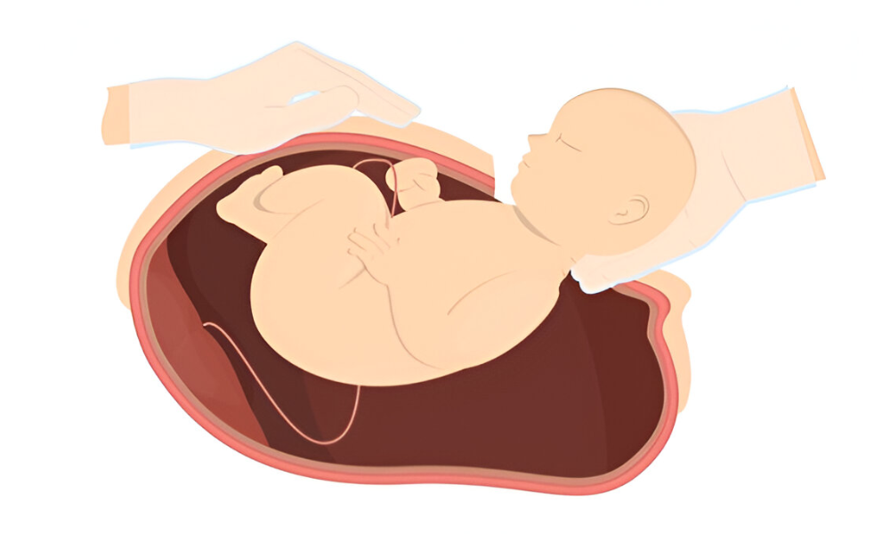 Shairaksha | Cesarean Deliveries