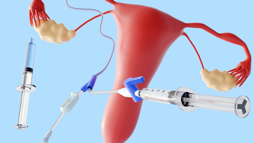 Shairaksha | How Long Does IUI Fertility Treatment in Chennai Take?