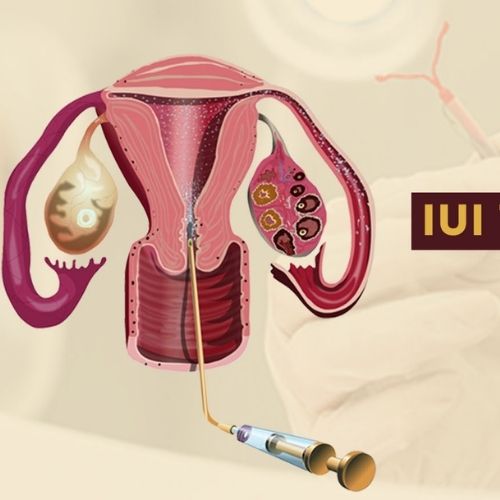 IUI